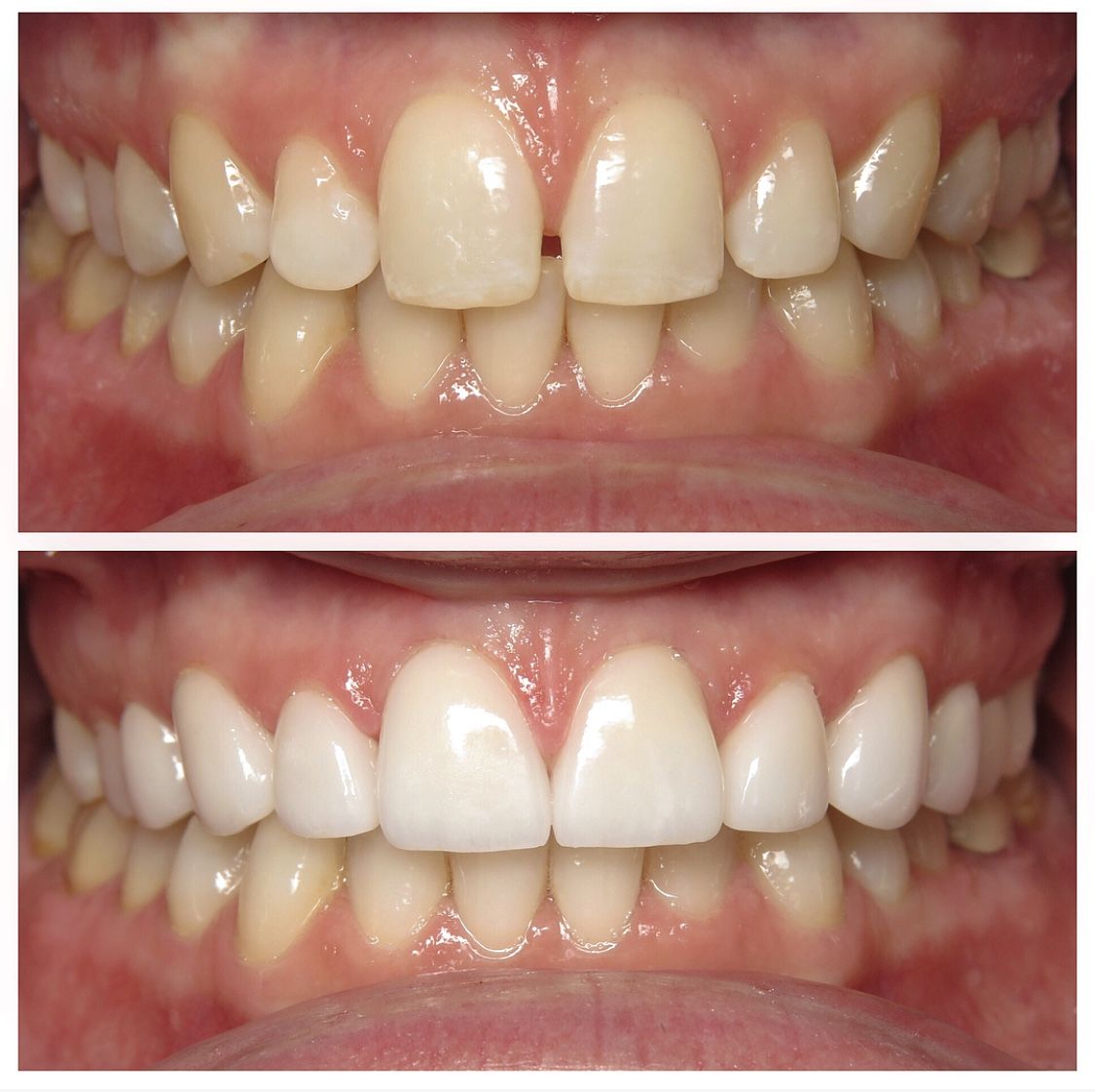 Before and after of discolored teeth